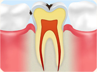C1 【エナメル質の虫歯】