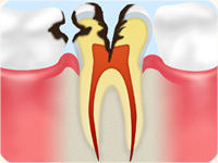 C3 【神経まで達した虫歯】