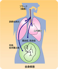 歯周病菌が招く全身疾患